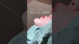 【3DEライン形成】顎ができる瞬間#shorts
