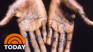 CDC Tracking 9 Cases Of Monkeypox Across 7 States
