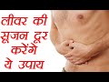 Liver Swelling Treatment with Home Remedies, लीवर की सूजन और गर्मी दूर करेंगे ये उपाय | Boldsky