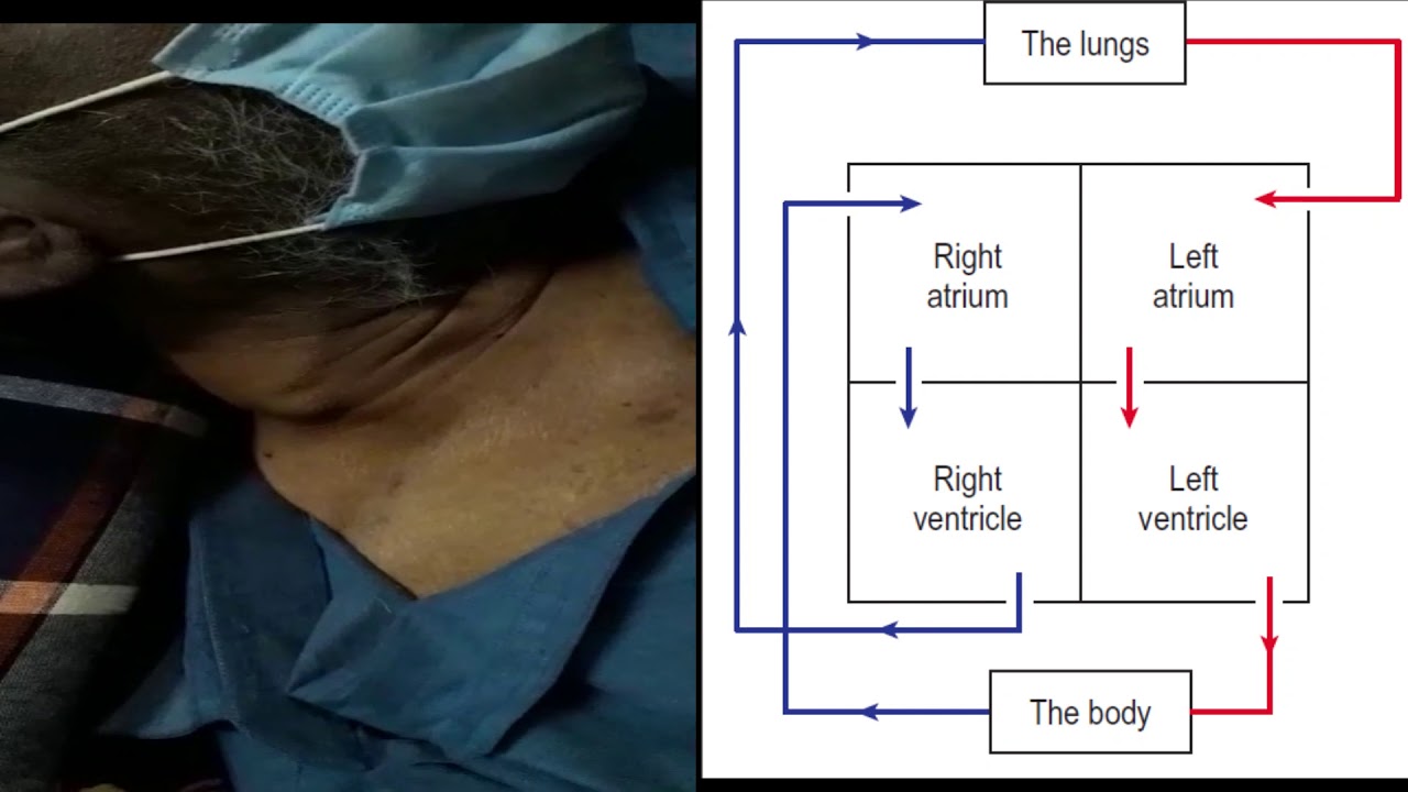 Raised JVP with Mechanism YouTube