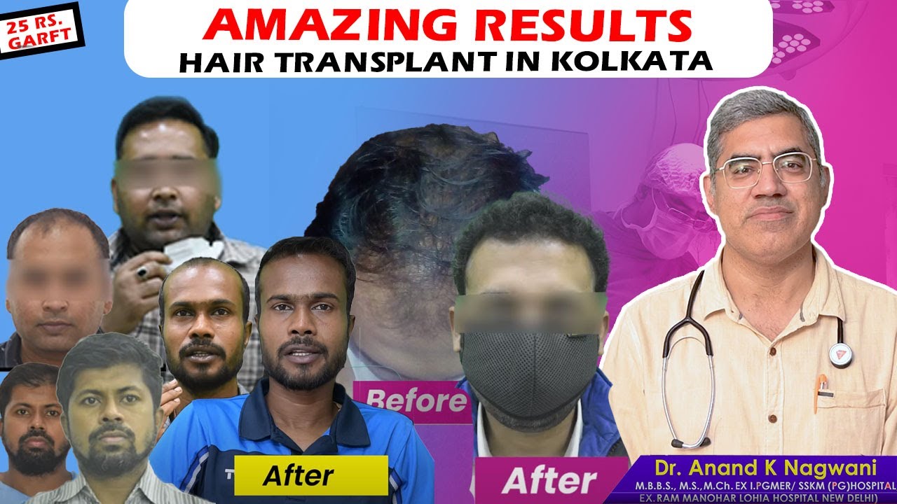 Best Hair Transplant in Kolkata Cost of Hair Transplant in Kolkata