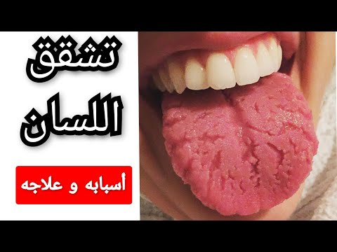 تشقق اللسان أعراضه أسبابه و علاجه تشقق اللسان اللسان    د إيريني أبادير