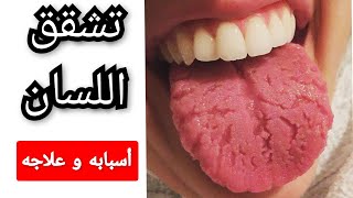 تشقق اللسان أعراضه أسبابه و علاجه #تشقق_اللسان #اللسان #fissured_tongue #tongue د/ إيريني أبادير