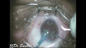 PEARLY WHITE CATARACT - PHACOEMULSIFICATION - Dr Saurav  Piya