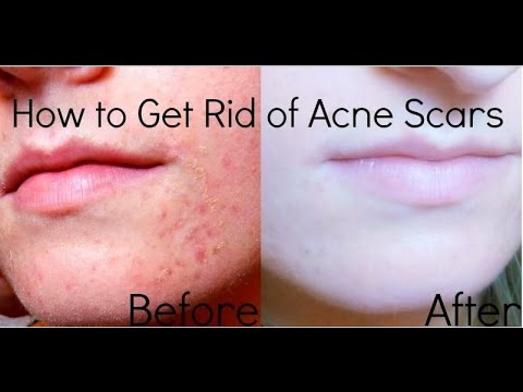 how to change your diet to get rid of acne