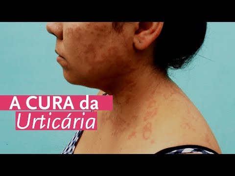 A cura da urticária