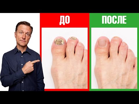 Video: Грибок жарганаттын скотч керекпи?