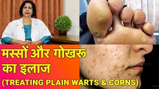 तिल, मस्से और गोखरू का ईलाज || Treatment of Plain Warts, Corns & Skin Tags