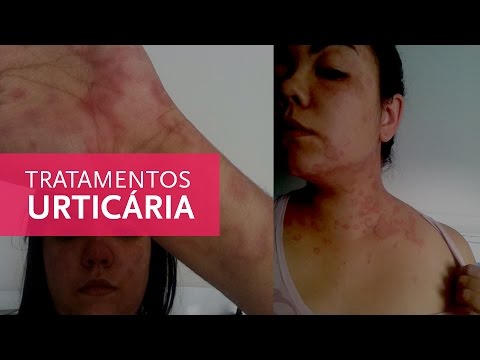 Tratamentos para urticária