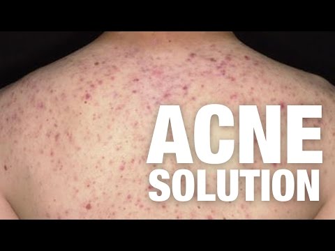 When i got acne, how i fixed it