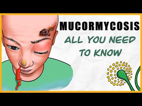 वीडियो: म्यूकोर्मिकोसिस का पता कैसे लगाया जाता है?