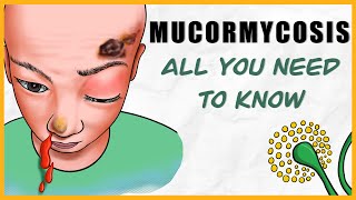 Mucormycosis: microbiology, types, signs & symptoms, diagnosis, treatment