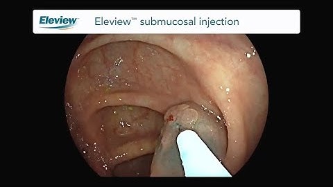 Endoscopic Mucosal Resection of a Sessile Polyp with Eleview™