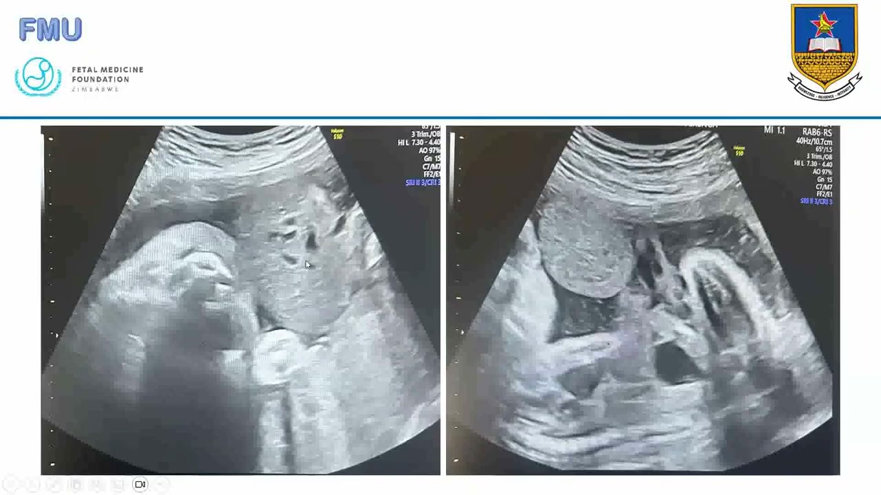 Complex Anterior Abdominal Wall Defects- Dr B Chidowore