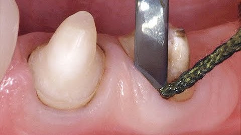 DSP432  Tissue management & Impressions in FPD