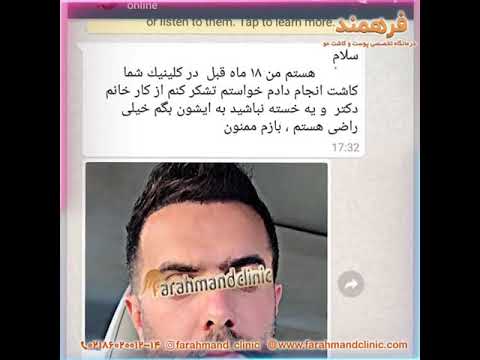 رضایت مراجعه کننده عزیز هجده ماه بعد از کاشت مو     