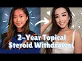 My Eczema and Topical Steroid Withdrawal Journey