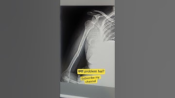 #shoets #shorts #xray #ray diagnosis#radiation #fracture #dislocation #shoulder
