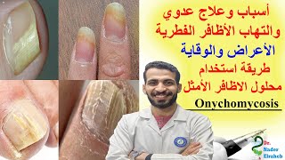 أسباب وعلاج عدوي والتهاب الأظافر الفطرية والاعراض والوقاية  | Fungal nail infections Onychomycosis