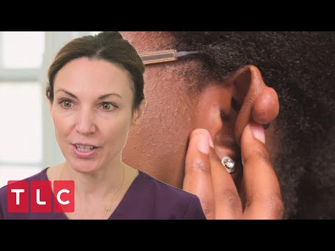 Patient Wants Her Ear Keloids Gone | Save My Skin