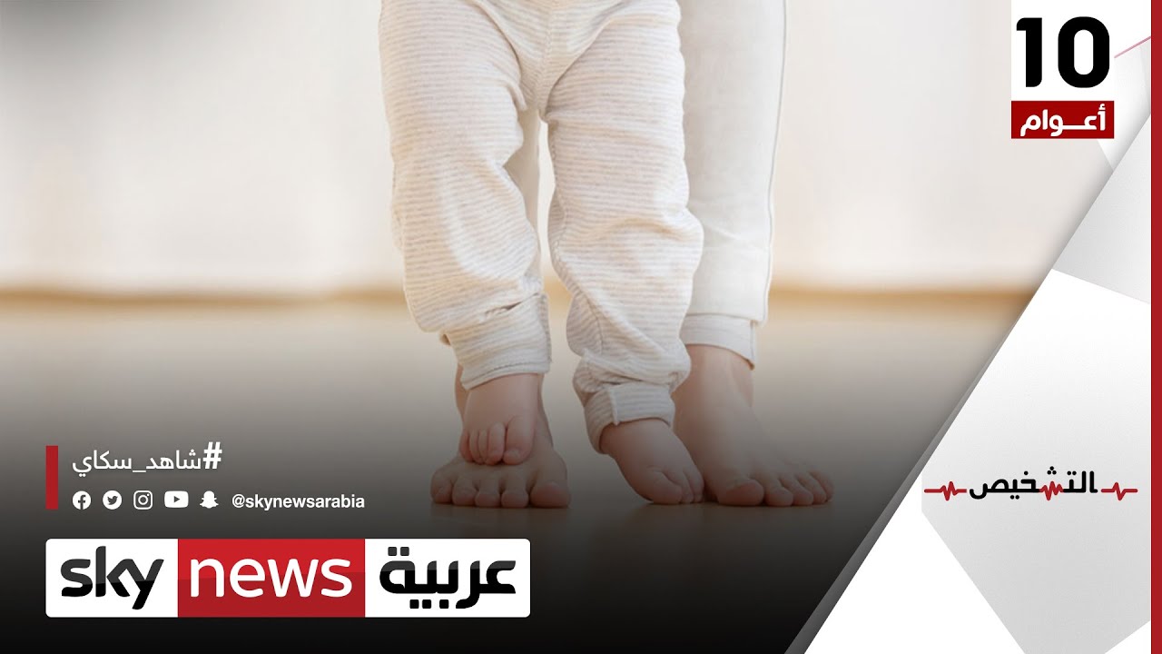 علاج القدم المسطحة عند الأطفال  | #التشخيص