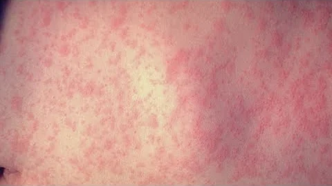 Measles cases on the rise in U.S.