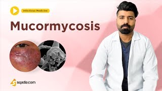 Mucormycosis | Infectious Medicine | Clinical Video Lectures | V-Learning | sqadia.com