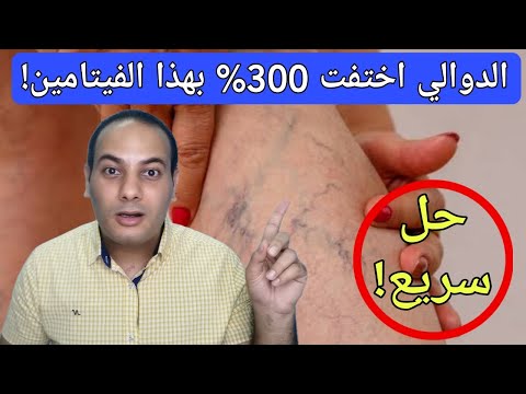 تناوله يوميا لعلاج دوالي الساقين نهائيا بنسبة 300 علاج الدوالي بدون جراحه افضل فيتامين للدوالي
