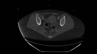 Pelvis CT: Nondisplaced Pelvic Fractures Investigating Pelvic Fractures On Ct