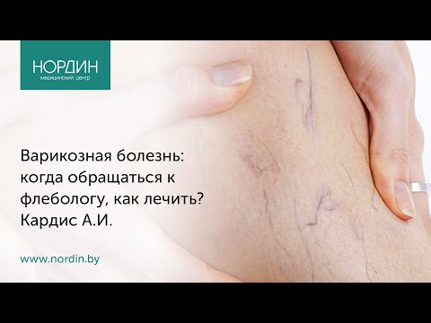 Варикозная болезнь: когда обращаться к флебологу, как лечить?