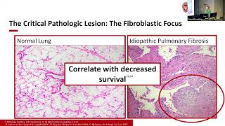 5/10/24 - A Mouse Model to Further Elucidate Mechanisms of Idiopathic Pulmonary Fibrosis