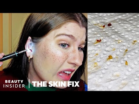 Earwax Cleaner Has Built-in Microscope | The Skin Fix