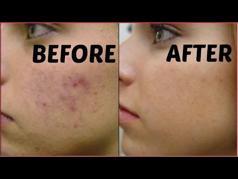 How To Remove Dark Spots  ||Acne Scars|| Black Spots In Just  Days || Get Flawless Glowing Skin