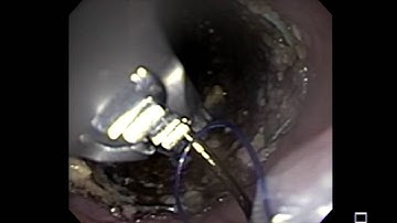 Endoscopic Suturing of Esophageal Stent - Mohamed Othman M.D.