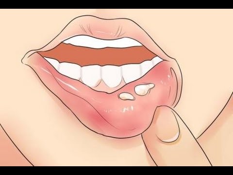 7 Remedios caseros para el herpes labial