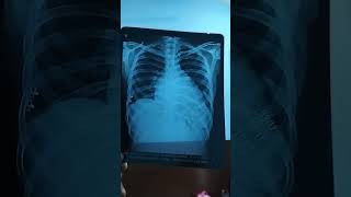 Chest X- Ray Reveals Cardiomegaly Size Increase