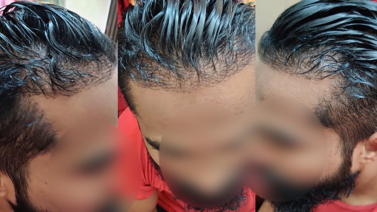 SCAM ALERT Hair Transplant aisa hota hai? YouTube