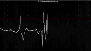 EMG teaching video 20: Myotonia