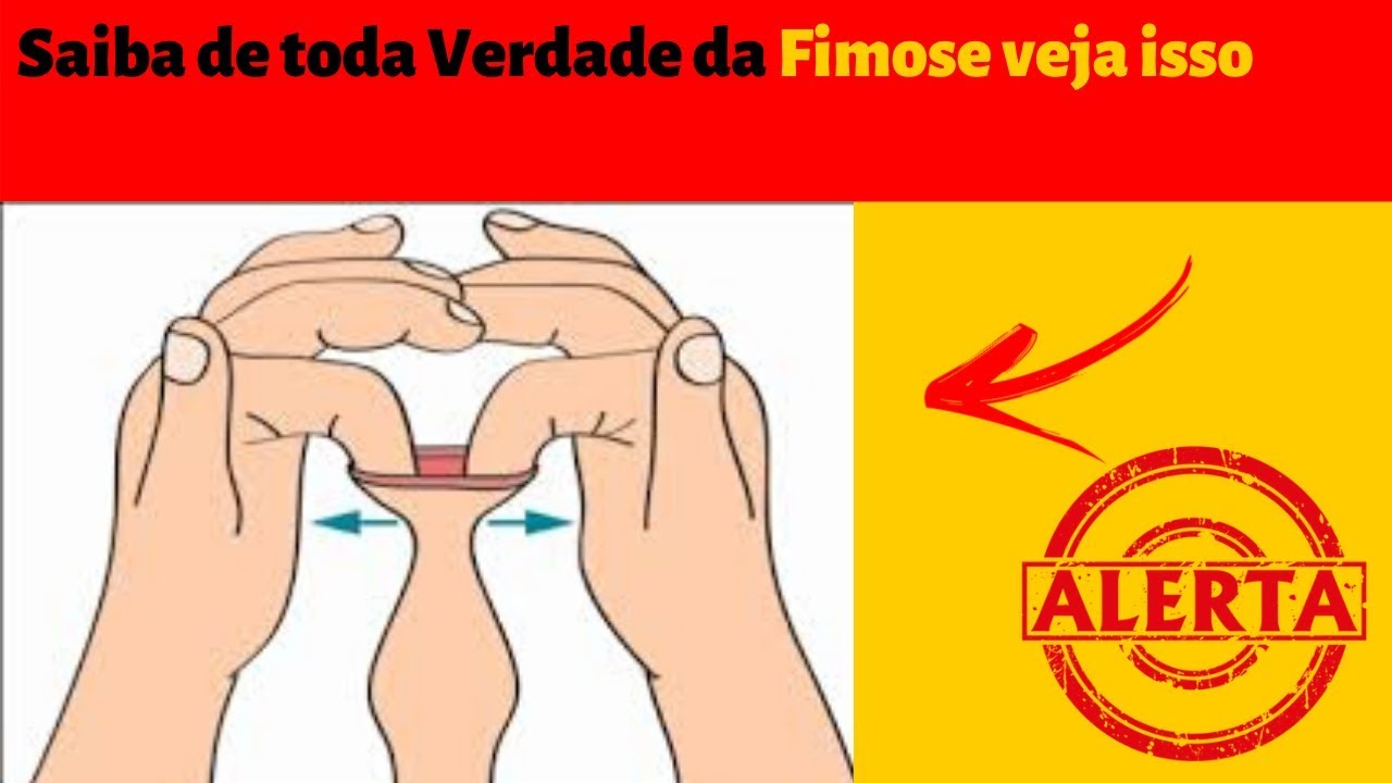 O Que E Fimose Fotos Modisedu 