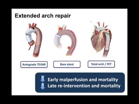 Approach to the Arch in Acute Type A Aortic Dissection