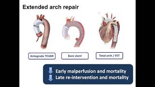 Approach to the Arch in Acute Type A Aortic Dissection
