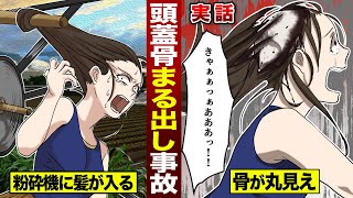 【実話】粉砕機に髪を巻き込まれ…「頭蓋骨」丸出しになった女。