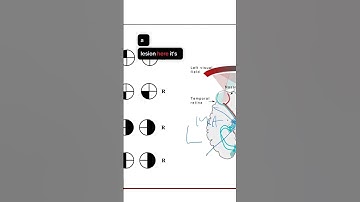 Homonymous Hemianopia Explained #neuro