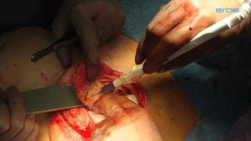 Electrosurgical pencil in mamma surgery