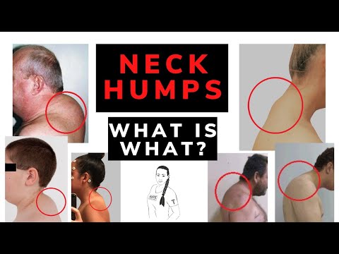 Wideo: Co powoduje tłusty garb między ramionami?