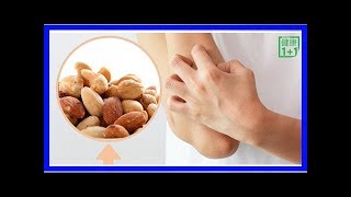 皮膚過敏發癢找不到原因？可能因為這些食物