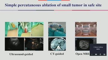 Prof Bo Zhai Better tools make for good work   Microwave Ablation for Complex Liver Tumor