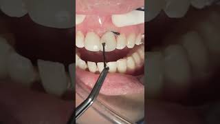 Closing Anterior Teeth Diastema Space With Composite Restoration