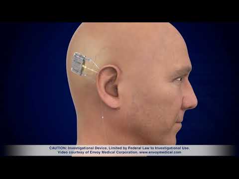 Meet the fully implanted Acclaim® cochlear implant, an investigational device