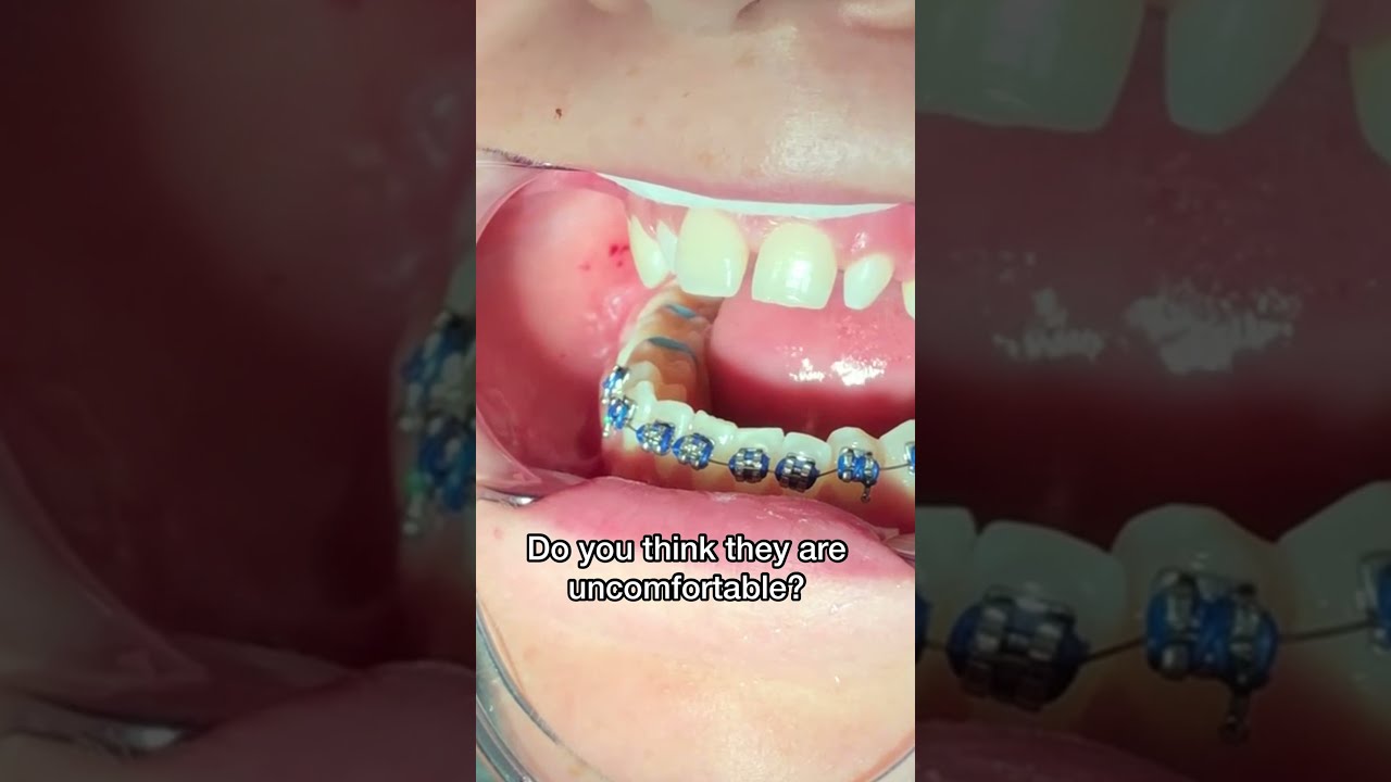 Spacers for Braces Ouch Tooth Time Family Dentistry New Braunfels